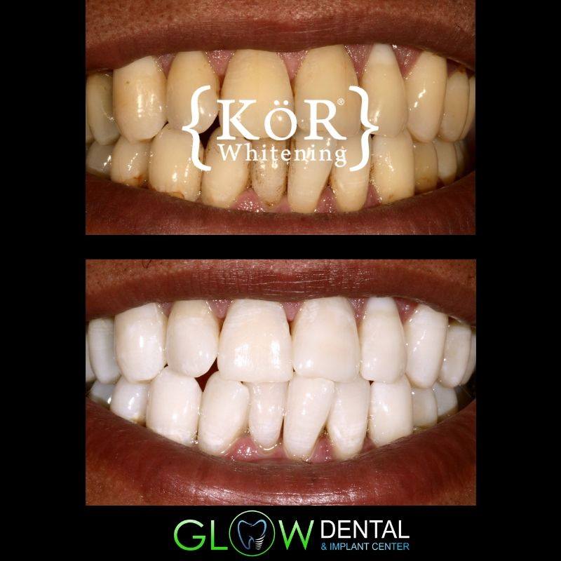 Glow Dental patient smiling after having his teeth whitened